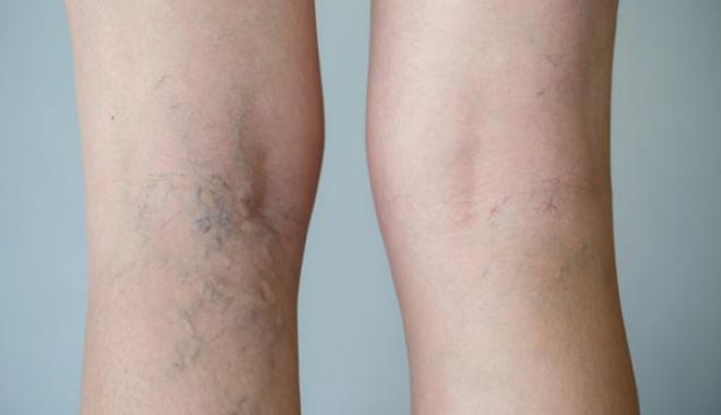 Picioare Venele Vindeca - Este posibil să se vindece complet varicoza