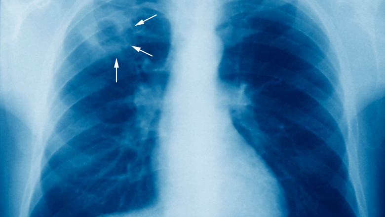 Tuberculoza poate fi transmisă printr-o simplă respirație - tuberc-1634666131.jpg